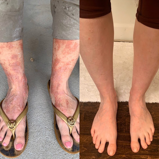 eczema threated with red light therapy before and after